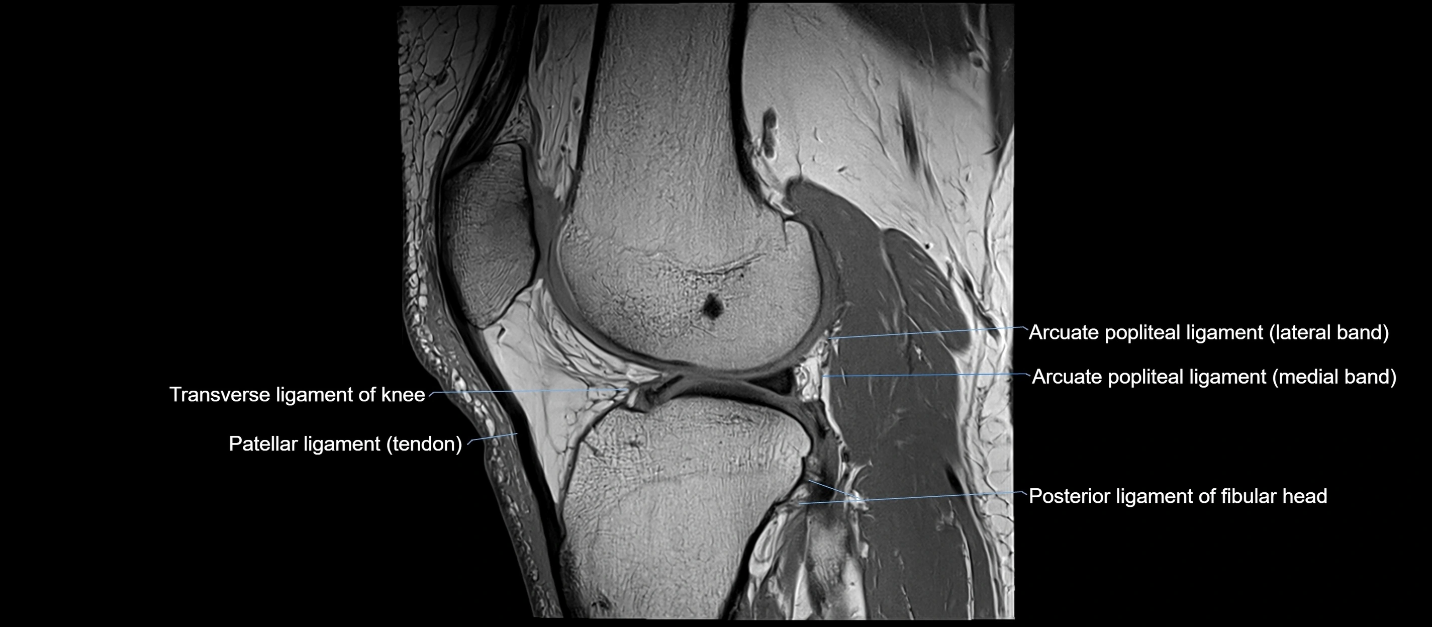 MRI sagittal  ligaments cross sectional anatomy 3T  radiology  image-img-00001-00031.webp